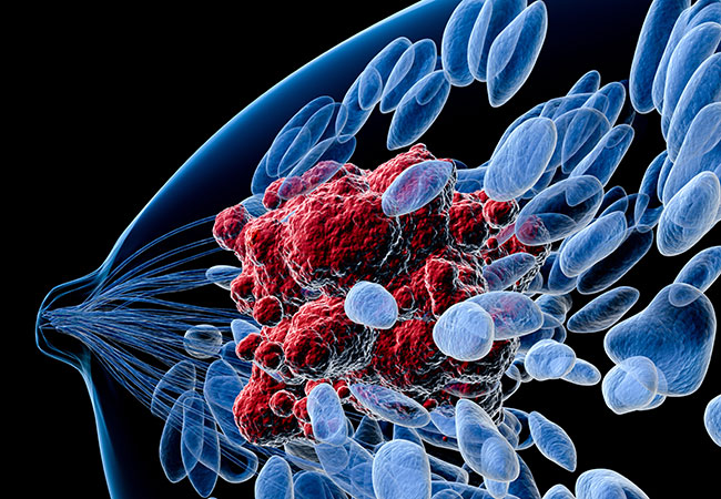 microbiota cancro al seno